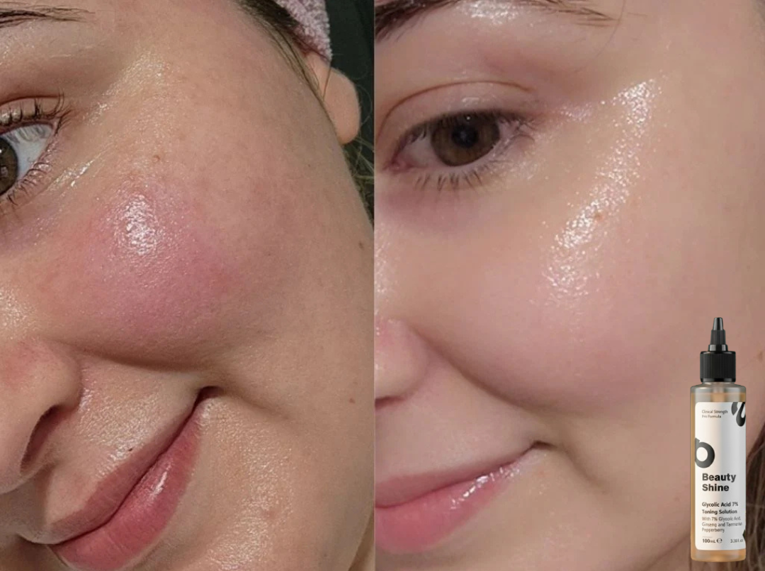 Glycolic Acid 7% Toning Solution (No Side Effects Results Warranted)