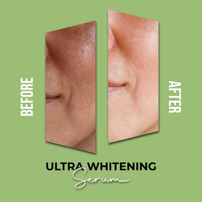 Ultra Whitening Serum (For Dark spots, acne scars, and sun damage)